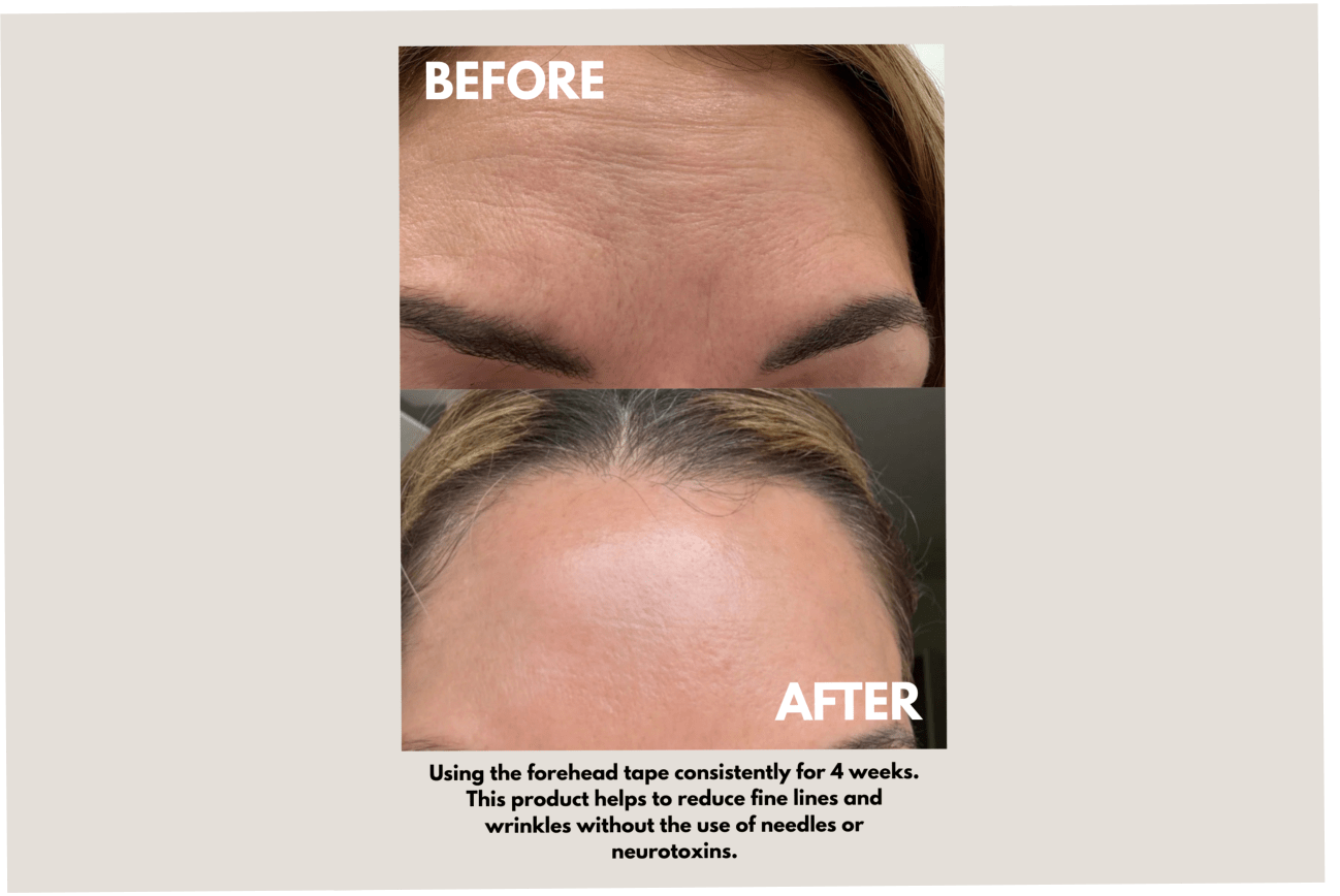 SEALD™ Forehead Tape – Wrinkle Smoothing Patches for Fine Lines - GISTMI